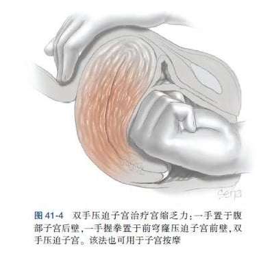 这是一张专业的产科医学教学示意图，通过3D渲染的方式清晰展示了双手压迫子宫治疗宫缩乏力的操作方法：一只手置于腹部托住子宫后壁，另一只手握拳置于阴道前穹窿位置压迫子宫前壁，双手配合对子宫进行压迫。图中还呈现了产妇体内的子宫与胎儿的位置关系，下方配有详细的文字说明，明确标注了操作要点，同时说明该方法也可用于子宫按摩，整体画面严谨清晰，用于讲解产科临床中的宫缩乏力处理方式。