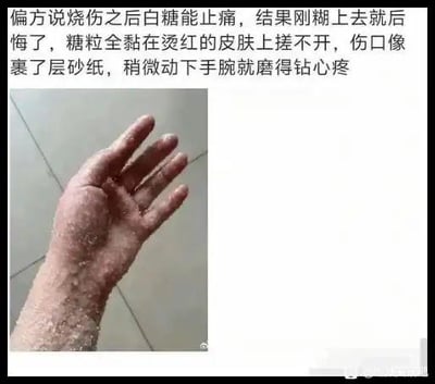 这是一张图文混排的图片，上方文字讲述了当事人轻信“烧伤后用白糖能止痛”的偏方，将白糖糊在烫伤的手上，结果糖粒全黏在烫红的皮肤上无法搓开，稍微动一下手腕就被磨得钻心疼的真实经历；下方是对应的实拍图，手的皮肤呈现烫伤后的状态，表面沾满了白糖颗粒，看起来十分狼狈。这张图没有双关、谐音梗等内容，主要用于警示大家不要轻信没有科学依据的偏方，避免遭受不必要的痛苦。