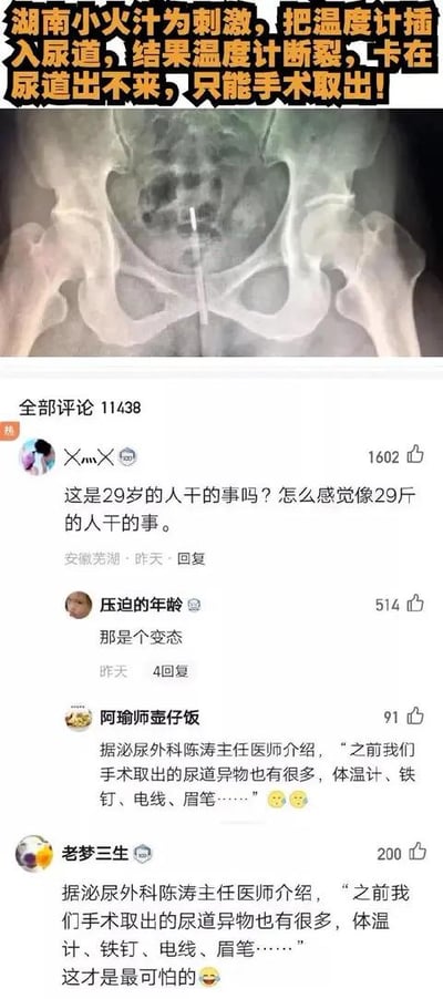 图片展示了一则令人震惊的社会新闻，标题为“湖南小火汁为刺激，把温度计插入尿道，结果温度计断裂，卡在尿道出不来，只能手术取出！”。上方是一张X光片，清晰显示了卡在骨盆区域的温度计。下方是社交媒体评论区，共有11438条评论，热门评论调侃当事人“这是29岁的人干的事吗？怎么感觉像29斤的人干的事”，还有评论称“那是个变态”，以及引用泌尿外科医生介绍类似尿道异物案例的评论。整体内容以图文结合的方式呈现了这起奇葩医疗事件及网友的反应。