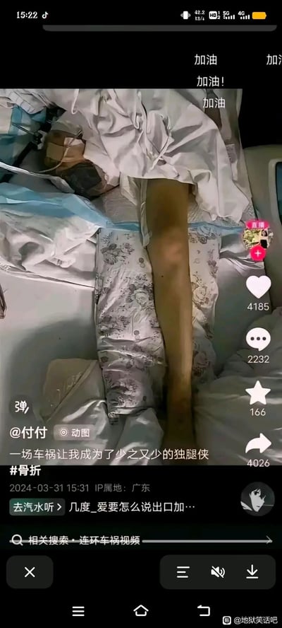 这是一张来自抖音平台的直播画面截图，发布者为用户@付付，发布时间为2024年3月31日15:31，IP属地为广东。画面中发布者躺在床上，通过将一条腿放置在带有花纹的长枕旁，利用视觉错位效果，让观看者产生其只有一条腿的错觉，配文称“一场车祸让我成为了少之又少的独腿侠”并附带#骨折标签，营造出搞笑的反差效果。画面右侧有抖音的直播关注、点赞、评论等互动按钮，上方有观众发送的“加油”类弹幕，截图右下角带有百度贴吧“地狱笑话吧”的水印，表明该截图被转发至该贴吧。