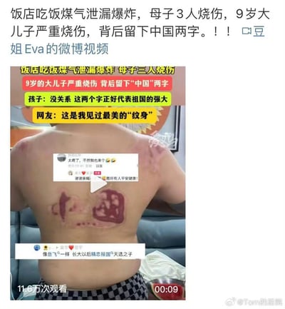 这是一张微博视频的截图，内容为一对母子在饭店遭遇煤气泄漏爆炸后受伤，9岁的大儿子背部严重烧伤，疤痕意外形成了类似“中国”的字样。男孩乐观表示这两个字代表祖国的强大，网友们纷纷评论，称这是最美的“纹身”，还有网友留言表达心疼与祝福，整体传递出乐观向上的正能量氛围。