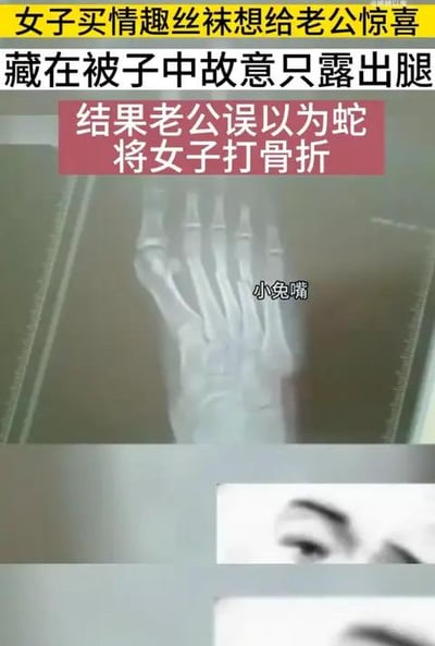 图片上方是黄色和红色的醒目文字，讲述了一个搞笑又荒诞的故事：一名女子想买情趣丝袜给老公惊喜，于是藏在被子中只露出腿部，结果老公误以为是蛇，导致女子被打骨折。图片下方是一张X射线影像，显示了骨折的骨骼，上面有“小兔嘴”的文字标记。整个图片采用了新闻式的图文结合方式，用夸张的情节制造喜剧效果。