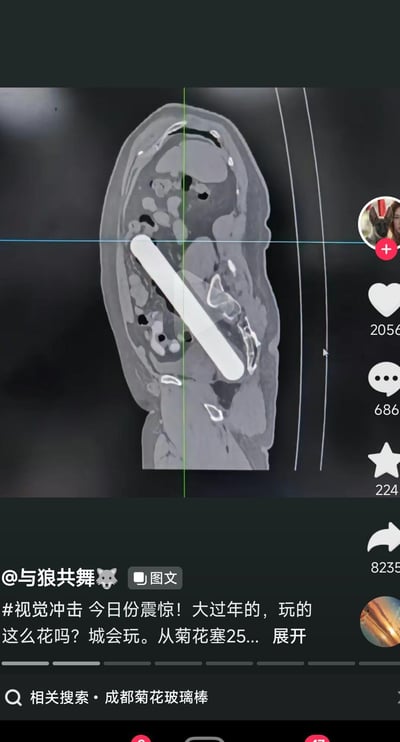 这是一张抖音平台的竖屏社交媒体截图，画面主体为一张人体腹部的矢状位CT影像，影像中清晰呈现一根长条形高亮度异物（玻璃棒）位于人体下腹部肠道区域，推测是经肛门塞入；截图下方是发布者“与狼共舞”的配文：“#视觉冲击 今日份震惊！大过年的，玩的这么花吗？城会玩。从菊花塞25...”，文字未完全显示，底部还有“相关搜索·成都菊花玻璃棒”的词条；截图右侧是抖音的互动界面，显示有点赞数2056、评论数686、收藏数224、转发数8235，以及发布者的头像，整体内容以猎奇的医疗案例为核心，用调侃的语气引发网友关注。