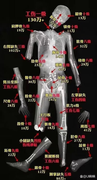 这是一张人体骨骼工伤赔偿参考图，以X光透视风格的人体骨骼为背景，用红色箭头和黄色/红色文字标注了不同骨骼部位受伤对应的工伤等级和赔偿金额。图中详细列出了从颅骨到四肢各部位的工伤评级标准，例如"工伤一级 130万+"、"眉骨十级 13万"、"右臂缺失三级 102万+"等，覆盖了全身主要骨骼的损伤赔偿参考价。