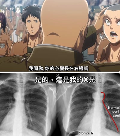 这是一张由上下两部分组成的梗图。上半部分是《进击的巨人》动画截图，显示几位调查兵团成员，其中一人问道：'我问你,你的心脏长在右边吗'。下半部分是两张胸部X光片对比，右侧X光片用红色箭头将胃标记为心脏位置，并配有文字'是的，这是我的X光'。这张梗图通过将动漫中的经典台词与医学图像幽默结合，创造出一种荒诞的喜剧效果。