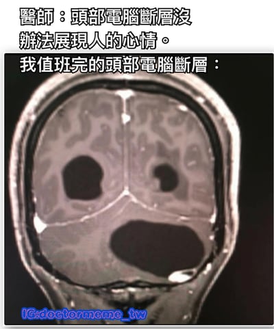 這是一張幽默梗圖，上方文字顯示「醫師：頭部電腦斷層沒辦法展現人的心情。」，中間文字為「我值班完的頭部電腦斷層：」，下方是一張腦部CT掃描圖像，圖中顯示腦部有多處大型黑色空洞，幽默地表達了值班後腦力耗盡、頭腦空空的狀態。
