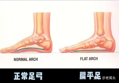 图片为左右并排的足部骨骼解剖对比图，左侧标注为'NORMAL ARCH'（正常足弓），显示明显的足弓弧度；右侧标注为'FLAT ARCH'（扁平足），足弓结构扁平。图中用橙色和粉色显示骨骼与软组织，绿色线条高亮足弓区域，底部配有中英文标签，清晰展示两种足弓类型的骨骼差异，属于医学科普类解剖学插图。