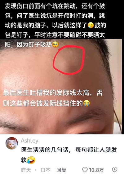 这是一张竖屏社交平台截图，博主分享自己开颅手术后的额头状况：红圈标注的凹陷是开颅时打的洞，能感觉到内部大脑在跳动，另一处鼓包是手术植入的钉子，医生叮嘱需避免磕碰与暴晒，因为钉子吸热。最后医生还吐槽博主发际线过高，否则这些术后痕迹都会被头发遮挡。下方网友评论“医生淡淡的几句话，每句都让人腿发软”，内容既有术后恢复的无奈，又因医生的吐槽增添了搞笑的反差感。