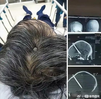 这是一组多图拼接的静态图，左侧为实拍图，呈现了一名头发花白的男子趴在病床上的状态，其头顶露出一个金属异物，背景能看到病床的护栏，显示场景处于医疗环境中；右侧是三张头部CT影像的屏幕截图，清晰展示了一根长杆状物体从男子头顶贯穿入颅内的位置和状态，直观呈现了伤者严重的伤情，整体画面给人惊险、震撼的感受，属于意外受伤后的医疗记录类图片。