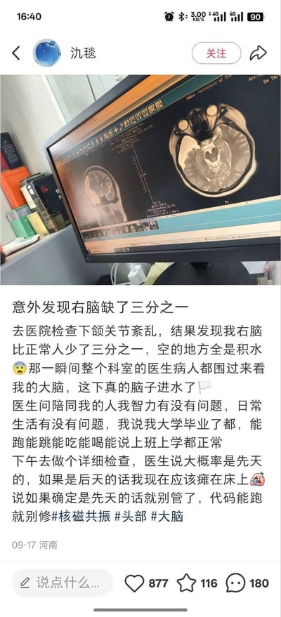 用户因下颌关节紊乱前往医院检查，在进行脑部核磁共振时意外发现自己右脑缺失了三分之一，空缺部位为积水。本人日常状态完全正常，已大学毕业，能正常工作生活。科室的医生和病人都围过来查看影像，用户玩梗称自己“这下真的脑子进水了”，医生判断大概率为先天情况，还调侃“代码能跑就别修”。
双关梗说明：“脑子进水了”在这里既是字面意义的脑部存在积水，也借用了网络梗的表述，形成趣味反差。
