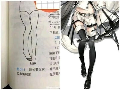 这是一张左右对比图，左侧是医学教材里的图61-1髋关节后脱位典型畸形的线稿，呈现出双腿并拢、双脚内旋的病症姿态，旁边配有部分关于该病症的医学文字内容，图注标注为“图61-1 髋关节后脱位典型畸形”；右侧是手游《明日方舟》中的干员白金的官方立绘，白金的腿部姿势与左侧的医学畸形图高度相似，二者被拼接在一起形成趣味对比，玩了姿势巧合的梗，通过二次元角色姿态和医学病症图示的撞型，制造出搞笑的反差效果。