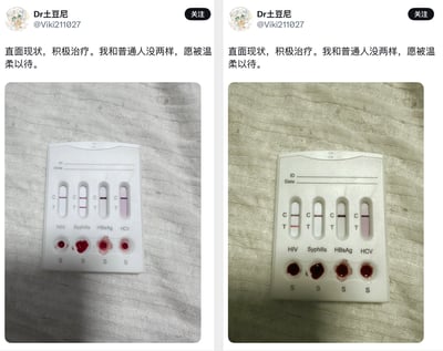 整张图为左右拼接的两张社交媒体动态截图，两张动态均来自同一用户“Dr土豆尼”，配文完全一致，均为“直面现状，积极治疗。我和普通人没两样，愿被温柔以待”，下方配图均为HIV、梅毒、乙肝、丙肝四联检测试纸。左侧截图中的试纸显示梅毒（Syphilis）检测项为阳性，右侧截图中的试纸显示HIV检测项为阳性，两条动态发布时间间隔极短，不符合疾病感染及治愈的客观生理规律，明显存在造假嫌疑。