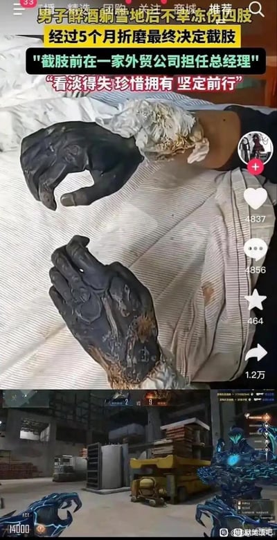这是一张上下拼接的玩梗图，上半部分是抖音平台的短视频截图，内容为一名曾任职外贸公司总经理的男子，因醉酒躺卧雪地导致四肢严重冻伤，历经5个月治疗后最终决定截肢，画面展示了他冻伤坏死的双手；下半部分是射击游戏《穿越火线》的生化模式游戏画面，玩家使用的爪子手套与上半部分的冻伤手外观高度相似，二者结合形成荒诞的玩梗反差。图中配文讲述了男子的遭遇，同时传递出“看淡得失 珍惜拥有”的感慨，利用真实受伤画面与游戏道具的相似性制造笑点。