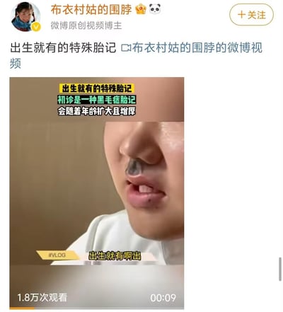 这是微博原创视频博主「布衣村姑的围脖」发布的一条医疗科普视频截图，视频介绍了一位患者出生就有的特殊黑毛痣胎记，这种胎记初诊为黑毛痣，会随着年龄增长扩大且增厚，截图展示了患者唇部上方的胎记症状，视频配有相关说明文字，该视频在微博获得1.8万次观看，时长9秒。