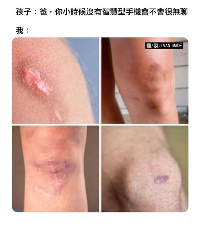 这是一则网络搞笑梗图，采用图文混排的形式，顶部首先呈现孩子的提问内容：“爸，你小时候没有智慧型手机会不会很无聊”，紧接着标注“我：”，下方是2×2拼接的四张实拍图，分别展示了四肢皮肤上不同形态、不同恢复阶段的疤痕，以此形象又幽默地回应孩子的问题：父辈童年没有智能手机时，常在户外嬉戏打闹，时常受伤，生活非常充实，完全不会觉得无聊，也生动体现了两代人童年娱乐方式的明显差异。