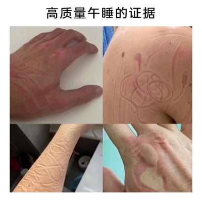 这是一张由四张实拍图片拼接而成的静态梗图，图片顶部配有文字“高质量午睡的证据”。四张图分别展示了不同人体部位因午睡留下的搞笑压痕：左上是手背被压出的类似布料纹理的红色压痕，右上是皮肤上被压出的酷似耳机线缠绕的印记，左下是小臂上被压出的织物纹路状痕迹，右下是手背上被压出的爱心形状压痕。这些痕迹都是人们在午睡时，长时间趴在有纹理的桌面或靠在特定物品上睡熟后留下的，用夸张且幽默的方式调侃了午睡睡得深沉、香甜的状态，贴近职场人或学生党午睡的日常场景，充满生活趣味。