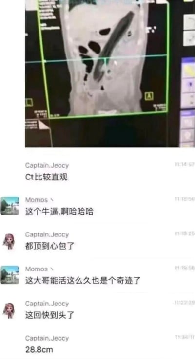 这是一张结合医学CT影像与医护人员聊天记录的截图。上方的CT扫描图清晰显示，患者体内存在一根长达28.8cm的长条状异物，异物位置已顶至心包；下方是两位医护人员（Captain.Jeccy与Momos）的聊天对话，二人针对该特殊病例展开讨论，惊叹患者能存活至今是奇迹，同时提及异物已危及心脏区域，患者情况危急。
无谐音梗、双关或暗示内容。
