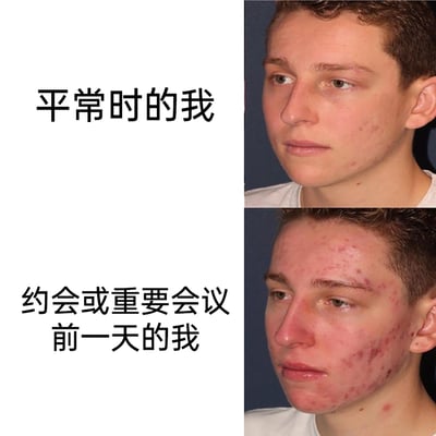 这是一张采用上下对比形式的图文混排静态图，图中展示了同一个男性的两种脸部皮肤状态：上方配文“平常时的我”，对应男性脸部仅有少量淡红色痘印和痘痘，皮肤状态相对稳定；下方配文“约会或重要会议前一天的我”，对应男性脸部大面积爆发红色痘痘，痘印和痘痘密集，皮肤状态糟糕。该图精准吐槽了许多人都会遇到的尴尬经历——在需要保持良好形象的重要场合前，皮肤状态突然变差，引发了有类似经历人群的强烈共鸣。