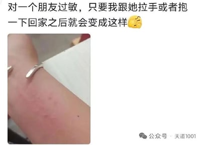 这是一张图文混排的搞笑梗图，顶部配文写着“对一个朋友过敏，只要我跟她拉手或者抱一下回家之后就会变成这样”，末尾搭配一个捂脸笑的表情；下方配图为一只佩戴着银镯子的手腕，手腕部位的皮肤有明显的泛红压痕，看似是过敏反应，实际是银镯子长时间佩戴挤压留下的痕迹，发布者用开玩笑的方式编造出“对朋友过敏”的离谱理由，趣味性十足。
