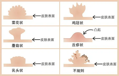 该图为皮肤病变形态对比示意图，通过六个方格展示不同类型皮肤表面病变的外观特征。每个方格均包含简化的病变形态插画及中文标签，从左到右、从上到下依次为：菜花状、鸡冠状、蘑菇状、丘疹状、乳头状和不规则形态。插画以浅棕色模拟皮肤组织，通过箭头标注"皮肤表面"位置，直观呈现各类病变的隆起形态差异，适用于医学教学或健康科普场景。