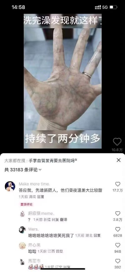 这是一张竖屏的社交媒体帖子截图，顶部是发帖用户实拍的自己的手掌，手掌血管明显发青发紫，用户配文“洗完澡发现就这样了”“持续了两分钟多”，图片下方显示平台的搜索提示“大家都在搜：手掌血管发青要去医院吗”，再往下是评论区，获赞17.2万的置顶热评玩类比梗，将发青发紫的手掌类比为成熟的紫色葡萄，借用新疆因昼夜温差大产出的水果甜度高的常识调侃“答应我，先啃新疆人，他们昼夜温差大比较甜”，引来了其他网友的搞笑回复，评论区整体氛围诙谐搞笑。