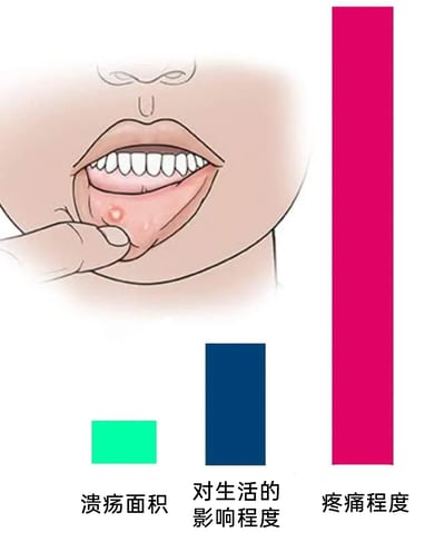 这是一张图文混排的静态健康科普图，左侧是卡通风格的人物，该人物眉头微皱、面露痛苦，用手指拉开下唇，展示出下唇内侧的口腔溃疡病灶；下方设置三个柱状图进行直观对比：绿色柱状图代表溃疡面积，是三者中尺寸最小的；深蓝色柱状图代表对生活的影响程度，尺寸处于中等；玫红色柱状图代表疼痛程度，是三者中尺寸最大的。这张图清晰地向观看者传达了口腔溃疡“病灶面积小，但疼痛感强烈，会对生活造成一定影响”的典型特征，帮助大众快速理解口腔溃疡的表现。