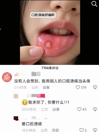 这是一张社交媒体截图，上半部分为竖屏短视频画面：一位真人用手指翻开下唇，露出内侧一颗明显的口腔溃疡，画面中央配文“口腔溃疡好痛啊”。溃疡表面的色块和小点组合起来有点像卡通小脸。下半部分是评论区，显示共有7704条评论。第一位来自山东的评论者使用这颗口腔溃疡的截图作为头像，并写道“没有人会想到，我用别人的口腔溃疡当头像”，获519个赞。来自江苏的网友回复“我求你了，你要什么！！！”，获43个赞；来自山西的网友接着回答“要口腔溃疡”，获3个赞。笑点在于评论者把令人疼痛的口腔溃疡直接当作头像，后续对话又以一本正经的方式完成“你要什么—要口腔溃疡”的无厘头回应。