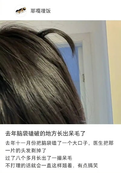 图片展示了一位网友的头发特写，头顶有一撮明显翘起的呆毛。下方配文讲述了去年十一月份因头部受伤磕破大口子，医生剃掉受伤部位头发后，经过八个多月长出一撮不打理就会一直翘着的呆毛，分享了这一略带搞笑的生活经历。
