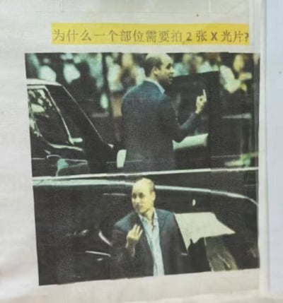 这是一张网络搞笑梗图，顶部是黄色背景条配黑色文字，提问“为什么一个部位需要拍2张X光片？”，下方分上下两部分拼接了两张奥巴马的实拍照片：上半部分他侧身站立对着侧面举起手比出1根手指，下半部分他正面朝向镜头举起手比出2根手指，用同一个人物的两个不同角度的画面，对应X光片需要拍摄正位、侧位两个角度才能全面判断病情的医疗常识，制造直白的笑点。