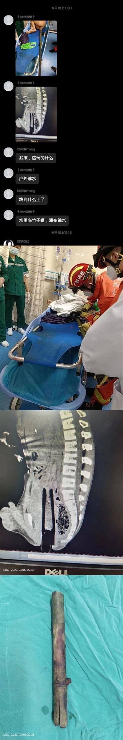 多张图片拼接而成的紧急救援场景，展示了消防员与医护人员协作救助伤者的过程。包含X光片显示体内金属异物，以及现场救援人员工作的画面，配有文字说明事件经过。