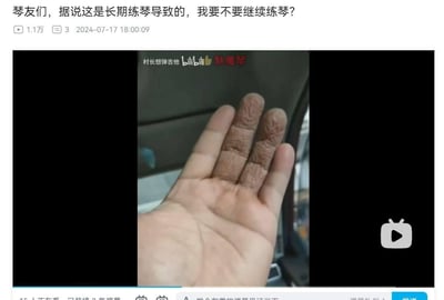 这是一张社交媒体截图，展示了一只手的特写，手指关节处有明显的纹理变化。图片上方配有文字："琴友们，据说是长期练琴导致的，我要不要继续练琴？"，表达了一位音乐爱好者对长期练琴可能导致手部变化的担忧和疑问。截图显示该内容有1.1万播放量，发布于2024年7月17日18:00:09。