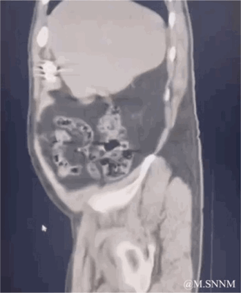 这是一段腹部CT扫描的动态GIF，原本用于医学检查的严肃影像，在动态播放时，肠道组织的扭动看起来像是在跳舞，形成了魔性又搞笑的视觉效果，将专业的医学内容转化为趣味十足的搞笑素材，没有双关或谐音梗，纯粹是视觉错位带来的幽默感。