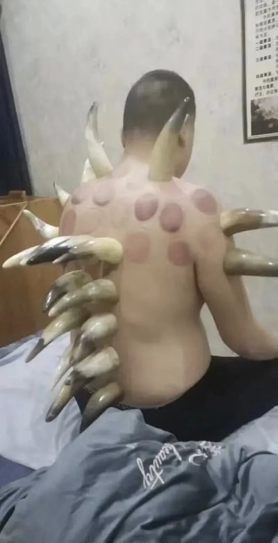 图片中一名男子背部做过拔罐治疗后留下多个圆形印记，同时背上被P上了类似龙鳞和龙角的装饰物，形成一种幽默的'龙脊'效果。男子坐在床上，背景有一面墙和一幅挂在墙上的字画。