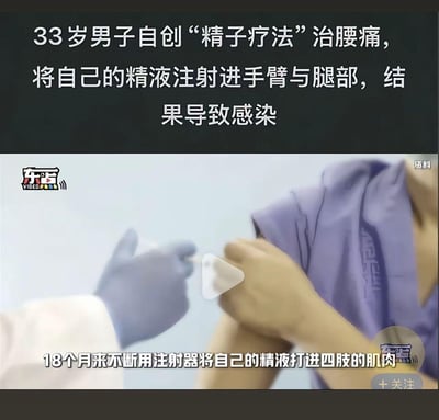 这是一则新闻视频截图，内容报道了一名33岁男子为治疗腰痛，自创“精子疗法”，在18个月内持续将自己的精液注射进手臂和腿部肌肉，最终导致身体感染的事件。图中展示了模拟注射的画面，上方和下方配有文字说明事件的核心内容，通过这一荒诞的事件传递健康警示信息。