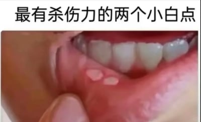 这是一张文字加注的静态真人实拍图，图片上方配有文字“最有杀伤力的两个小白点”，下方展示了一个人用手指拉开自己的下唇，露出下唇内侧的两处椭圆形口腔溃疡，溃疡呈现出白色的创面，周围的口腔黏膜泛红。这里的“杀伤力”是调侃口腔溃疡带来的强烈痛感，无论是进食、说话还是日常活动，都会被这种疼痛影响，引发有过口腔溃疡经历的人的强烈共鸣，是对生活中常见的小病痛的搞笑吐槽。