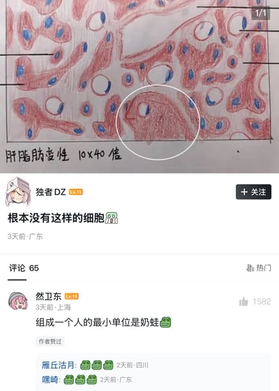 图片上半部分是一张手绘的组织切片图，下方手写标注“肝脂肪变性 10×40倍”。画面主要用红色绘制肝组织或细胞轮廓，用蓝色点出细胞核，并分布着许多白色圆形空泡，代表脂肪变性后形成的脂肪滴。图中还有数条黑色指示线，但没有填写标签。一个白色圆圈圈出了偏下方的一块红色结构：该结构的边缘、白色圆形空泡和蓝色小点组合后，看起来像一只面朝左侧的青蛙或蝌蚪，白色空泡像眼睛，左侧小缺口像嘴。下半部分是疑似 Bilibili 动态的社交媒体截图。用户“独者DZ”发布内容“根本没有这样的细胞😱”，定位广东，发布于3天前，显示有65条评论。热门评论中，用户“然卫东”写道“组成一个人的最小单位是奶蛙🐸”，获1582个赞并被作者赞过；随后有用户回复三只青蛙表情。笑点来自空想性错视：本应是病理绘图中的普通组织结构，却因涂色和轮廓意外像青蛙，网友便用“奶蛙”替换生物学概念中的“细胞”，制造荒诞感。现实中并不存在所谓“奶蛙”细胞，这只是手绘图中的偶然形似。