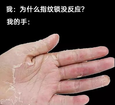 这是一张生活类搞笑梗图，上方配文“我：为什么指纹锁没反应？”，下方搭配一只手掌严重脱皮的实拍图并配文“我的手：”。图中的手掌及手指皮肤大面积脱落，原本的指纹区域皮肤缺失，用这种直观的画面幽默地解释了指纹锁无法识别的原因，通过夸张的生活小尴尬制造笑点，能够引发有过手部脱皮经历的用户的共鸣。