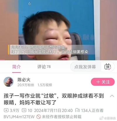 这是一张B站视频的截图，画面上方是双眼严重肿胀、几乎无法睁开的男孩，配文字幕显示妈妈称孩子放假不想写作业，揉了几下眼睛后就变成这样，推测是细菌感染；截图下半部分是B站视频的详情区域，视频作者为拥有20.9万粉丝的“陈必火”，视频标题调侃式写道“孩子一写作业就‘过敏’，双眼肿成球看不到眼睛，妈妈不敢让写了”，同时展示了视频数据：3.9万播放量、10条点赞，发布于2024年7月11日20:40，有134人正在观看，视频编号为BV1JM4m127EW，标注“未经作者授权禁止转载”，右下角还有微博用户@里神楽的水印。整体内容充满趣味，调侃了孩子抗拒写作业的状态，让人哭笑不得。