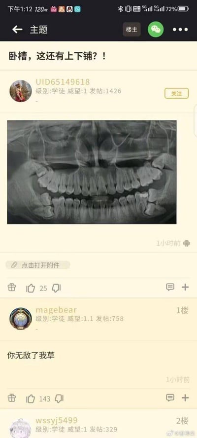 这是一张论坛帖子的截图，楼主UID65149618发布了一张口腔全景X光片，X光片中的牙齿呈现出罕见的上下两层重叠生长的状态，楼主用“卧槽，这还有上下铺？！”的标题来形容这一离谱的牙齿排列，充满调侃意味。楼主的帖子收获了25个点赞，1楼用户magebear回复“你无敌了我草”，表达了对这一罕见情况的惊叹，该回复获得了143个点赞。整个内容以“上下铺”的生活化梗来形容特殊的牙齿畸形，引发网友的趣味讨论，画面中还能看到楼主和评论用户的论坛等级、发帖量等信息，右下角带有微博用户@里神楽的水印，说明该截图被搬运至微博进行传播。