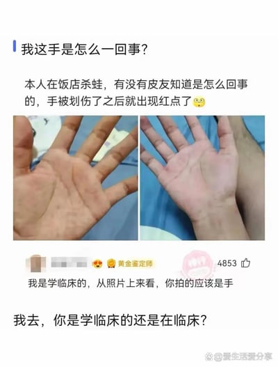 这是一张来自社交平台的图文内容截图，主体是一位在饭店从事杀蛙工作的网友，因为手部被划伤后出现红点，发布了自己手掌的左右对比图，向社区的“皮友”求助，询问手部异常的原因。随后一位标注“黄金鉴定师”、自称学临床的用户给出了完全没有针对性的神回复，称“从照片上来看，你拍的应该是手”，该评论获得了4853个赞。最后有网友针对这个无用回复发出吐槽：“我去，你是学临床的还是在临床？”，整个内容通过这种答非所问的神回复制造出搞笑的反差效果，属于网络上常见的搞笑互动段子。