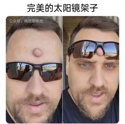 这是一张左右分栏的对比实拍图，图中男子额头长有一个凸起的肉瘤，左侧画面里他正常佩戴太阳镜，肉瘤位于镜架上方；右侧画面中他将太阳镜的镜梁部分架在这个肉瘤上，刚好可以稳定卡住太阳镜。搭配顶部的文字“完美的太阳镜架子”，利用身体的特殊特征制造出荒诞又搞笑的创意效果，让人感受到趣味十足的反差感和脑洞。