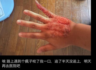 这是一张用于整蛊搞笑的梗图，图中手部通过特效化妆或P图手段，制作出类似被咬伤的狰狞伤口，还额外做出一根畸形的手指，营造出严重受伤的视觉效果；下方配文“唉 路上遇到个疯子咬了我一口，追了半天没追上，明天再去医院吧”，假装自己遭遇意外被人咬伤，实际上是用特效制造的虚假伤口，以此开玩笑、整蛊观看者。