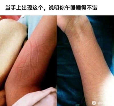 这是一张左右对比的静态图，图上方配有文字“当手上出现这个，说明你午睡睡得不错”。左侧展示了一只手臂压在浅色织物上后，皮肤表面留下的清晰红色织物纹路；右侧则是另一只手臂压在深色织物上后，皮肤表面留下的浅色织物纹路。这些纹路都是长时间趴睡后，手臂被织物挤压形成的痕迹，用这种生活化的趣味细节，调侃深度午睡后身体留下的印记，精准戳中了许多需要趴桌午睡的打工人的日常经历，引发共鸣。